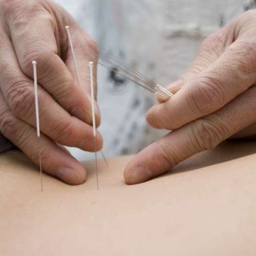 Dry-Needling-Ozark-Physical-Therapy-Specialists-Mountain-Home-AR